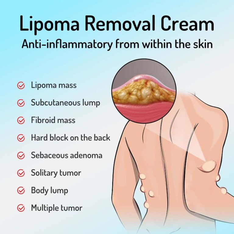 CurSkin Lipoma Treatment Ointment - Image 3