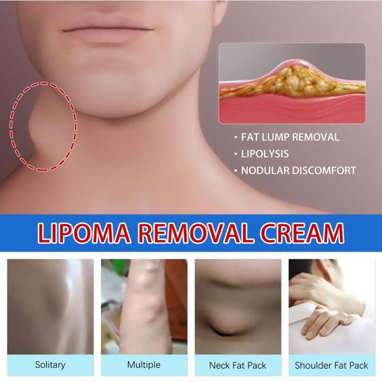 CurSkin Lipoma Treatment Ointment - Image 5