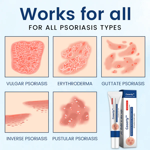 SootheGlow Psoriasis Treatment Cream - Image 5