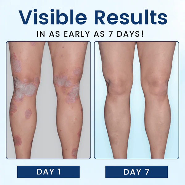 SootheGlow Psoriasis Treatment Cream - Image 8