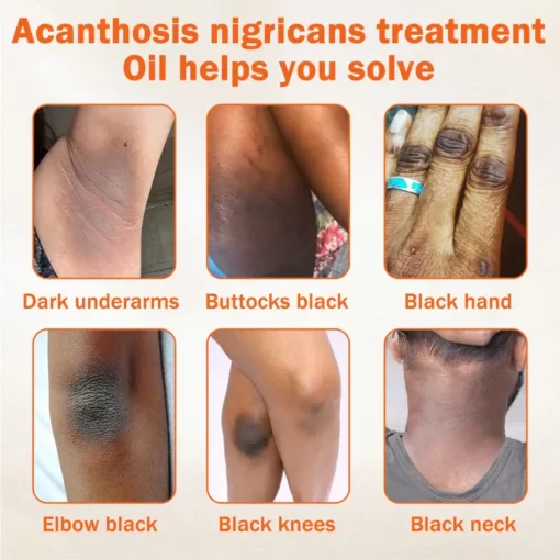 Oil Against Dark Spots & Acanthosis - Image 4