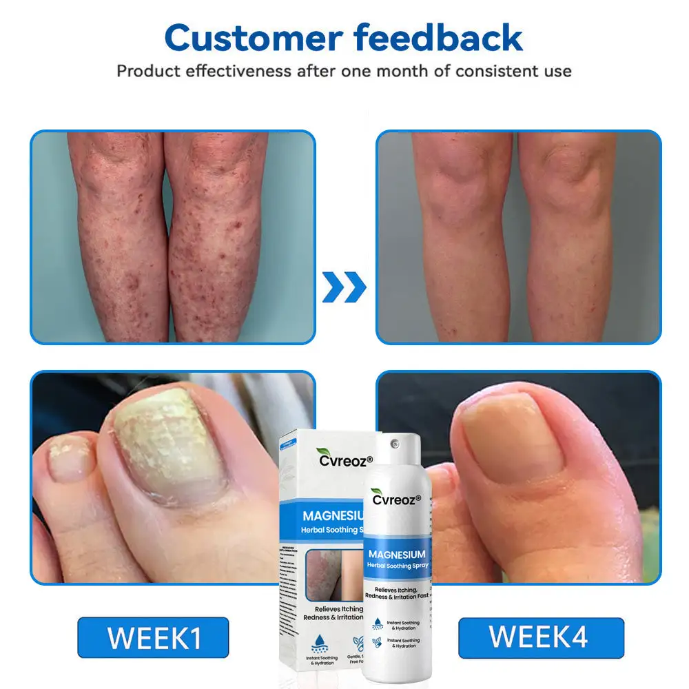 Cvreoz® Magnesium Herbal Psoriasis Spray ( Imported ) - Image 4