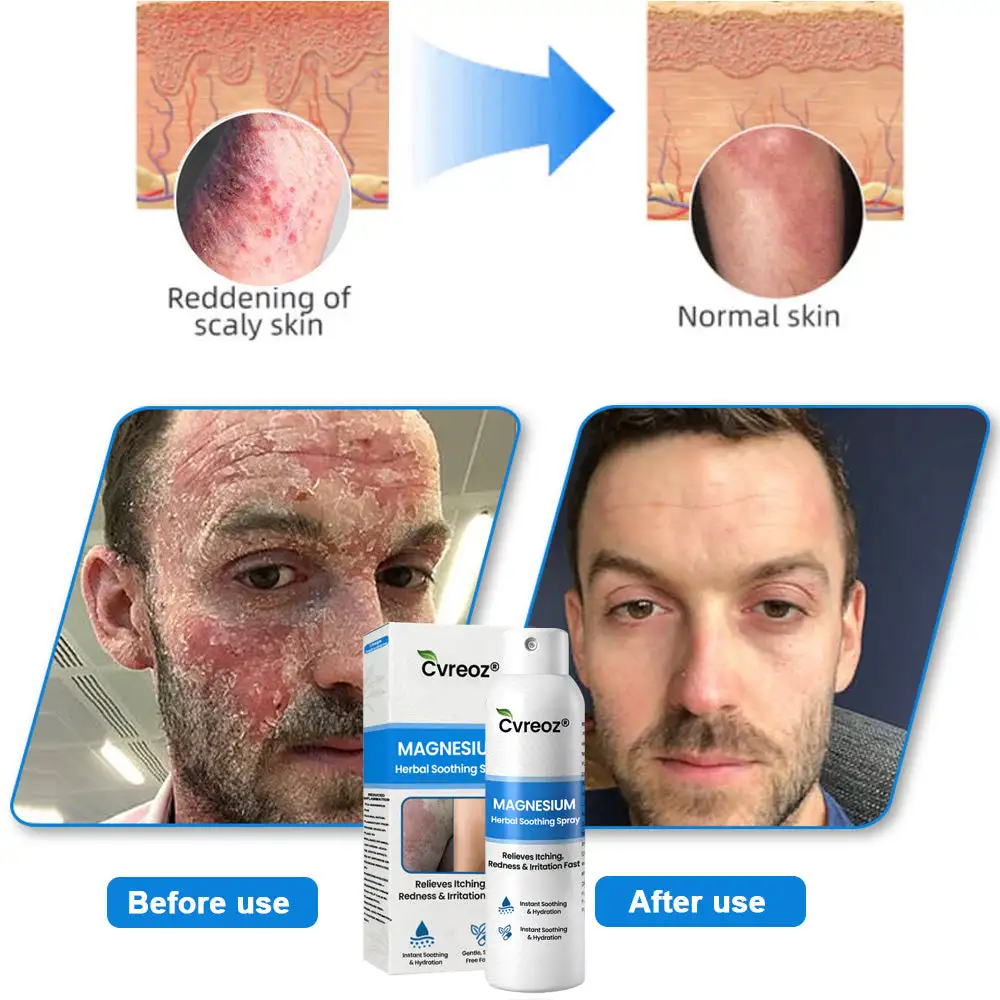 Cvreoz® Magnesium Herbal Psoriasis Spray ( Imported ) - Image 3
